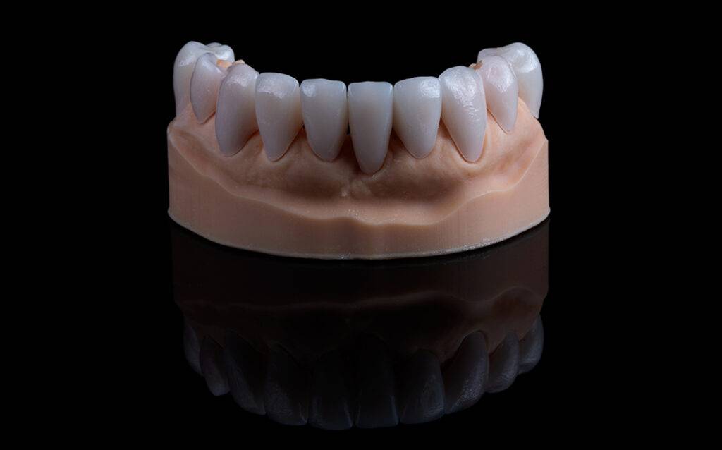 emax veneers