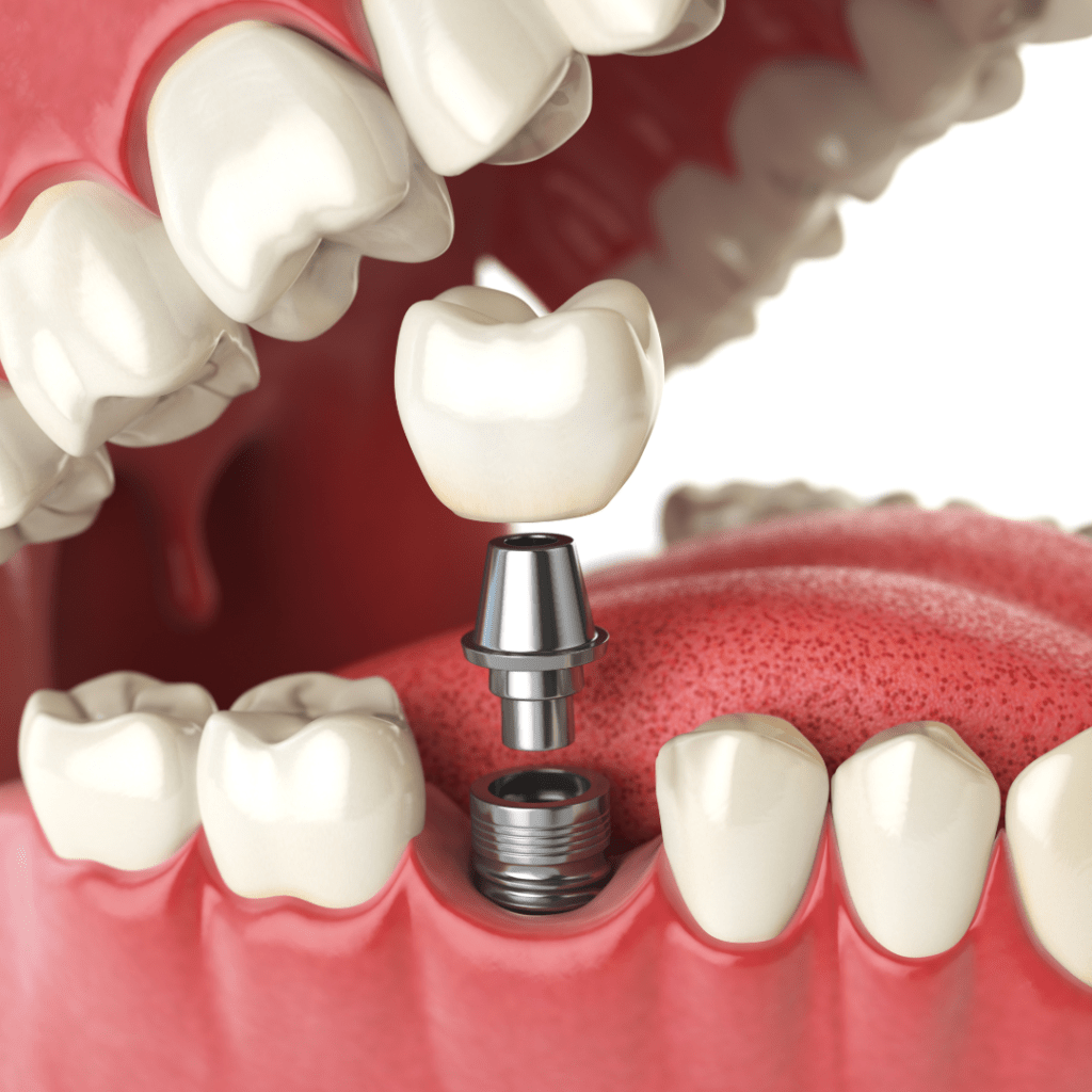 implantes dentales straumann marbella