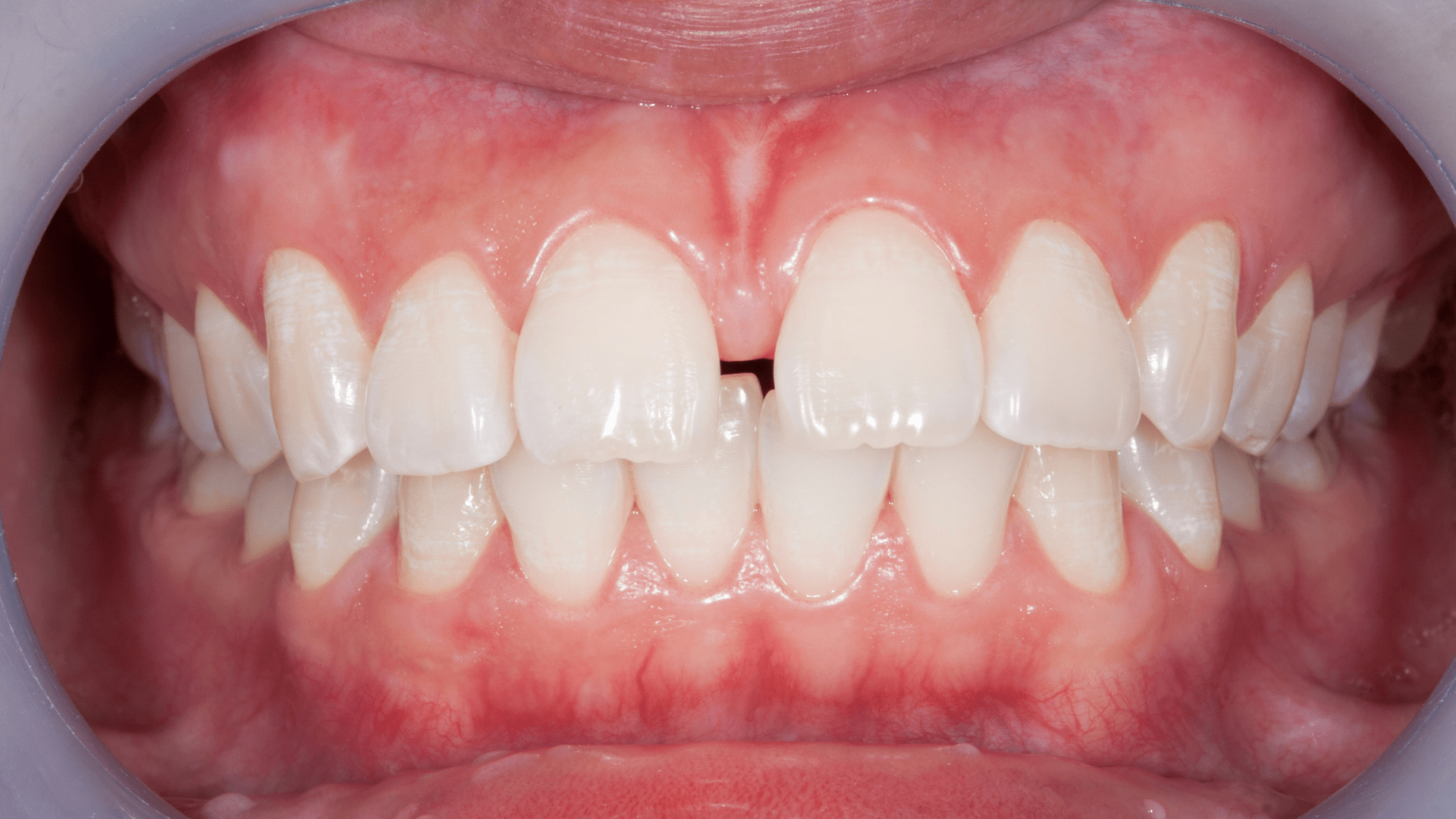 dental diastema