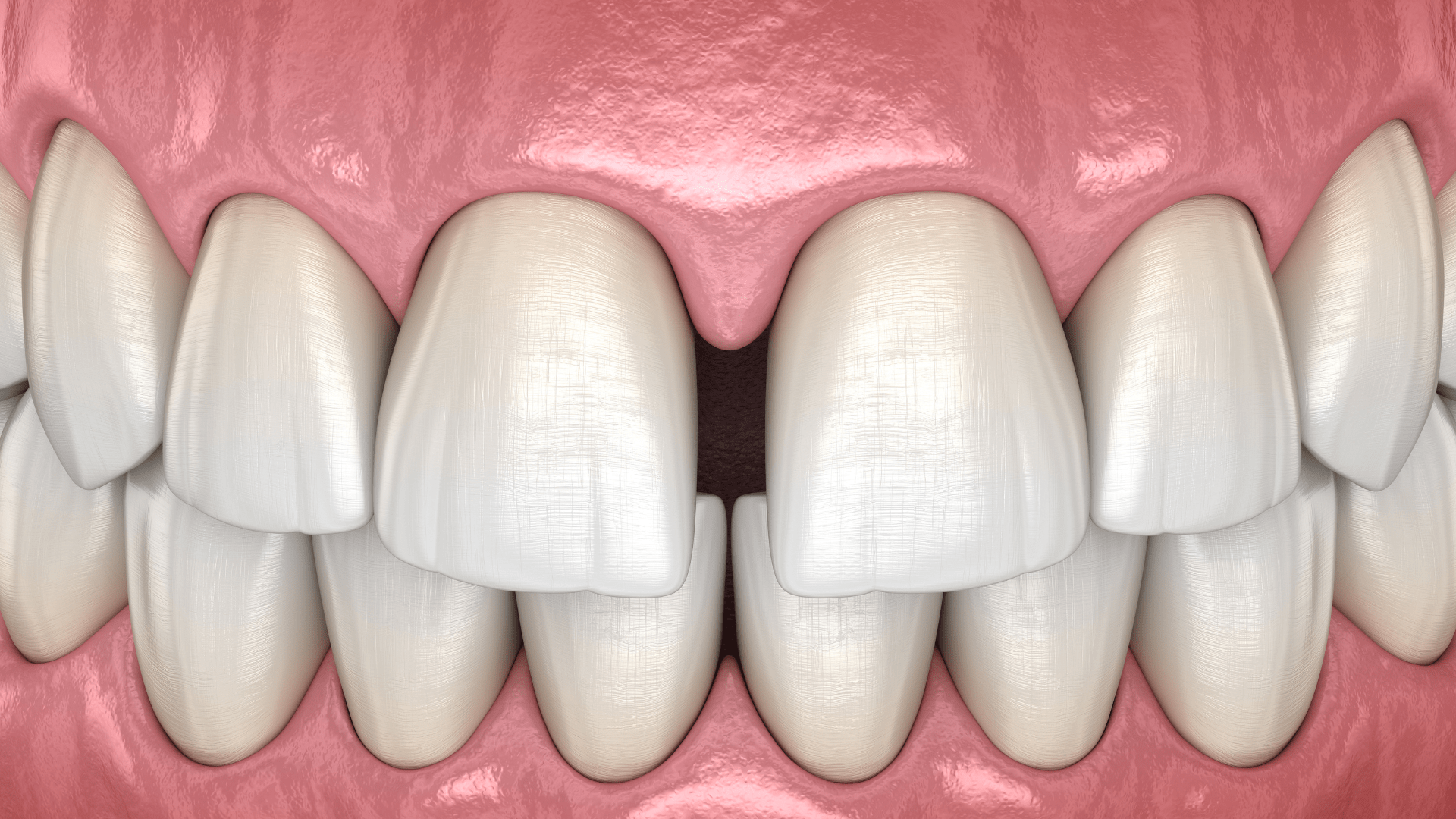 dental diastema